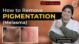 How To Cure Melasma  Latest Treatment For Melasma  Dr Nivedita Dadu [upl. by Magulac216]