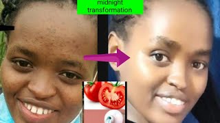 Tomato  colgate to remove pimples  how to remove blackspots and acne  how to smoothen your skin [upl. by Adnaluoy99]