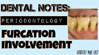 FURCATION INVOLVEMENT II DENTAL NOTES II STUDY WITH ME II PERIODONTOLOGY [upl. by Erica469]