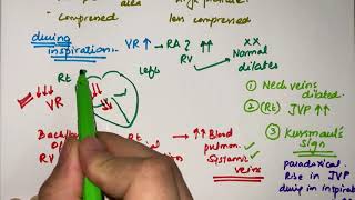 Cardiac tamponade  pathophysiology  clinical features  MEDICINE with DR SHAMAMA [upl. by Thora]