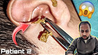 Ear Cleaning Opened Full ear infection  Ear wax Removal Part 2 [upl. by Namielus25]