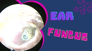 FUNGAL INFECTION EAR OTOMYCOSIS [upl. by Nodlehs]