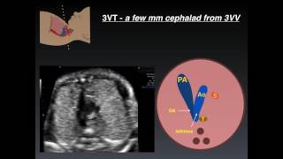 Three Vessel Tracheal View A Review of Normal and Abnormal Findings [upl. by Maxantia]