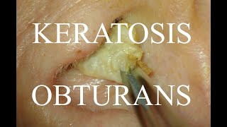 KERATOSIS OBTURANS COMPLETE IMPACTION  4KHD [upl. by Anjali]