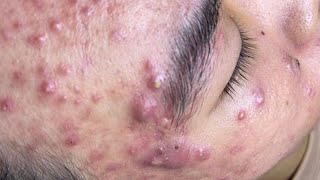 Big Cystic Acne Blackheads Extraction Blackheads amp Milia Whiteheads Removal Pimple Popping  5044 [upl. by Niatsirk]