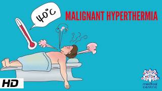 MALIGNANT HYPERTHERMIA Causes Signs and Symptoms Diagnosis and Treatment [upl. by Rehptsirhc]