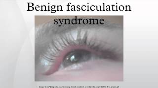 Benign fasciculation syndrome [upl. by Karisa]