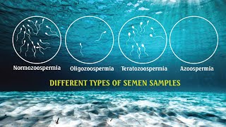 Semen analysis Samples OLIGOZOOSPERMIA ASTHENOZOOSPERMIA  TERATOZOOSPERMIA SPERM COUNT [upl. by Lee]