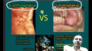 Erythroplakia Vs Leukoplakia Symptoms causes risk of malignancies [upl. by Hassi]