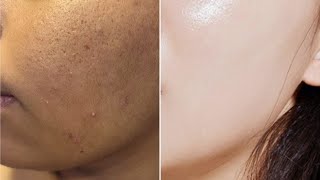 Comment se débarrasser des boutons sur le visage rapidement avec un masque à largile verte [upl. by Azpurua459]