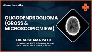 Oligodendroglioma Gross amp Microscopic View  MedvarsityOnlineLtd [upl. by Nahgam940]