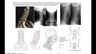 Radiographies du rachis cervical [upl. by Corella]