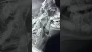 Adenoid and Tonsillar hypertrophy on lateral neck X ray [upl. by Narat]