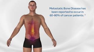 OsteoCool™ Bone RF Ablation – Minimal invasive spinal and extraspinal metastasis treatment [upl. by Garlaand]