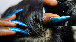 ASMR Allzoomed Full Head Scalp Nitpicking Whiteheads 1HR 🤯 [upl. by Lehsreh309]