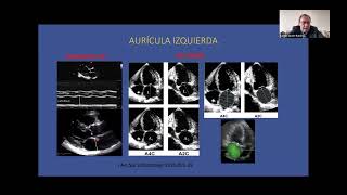 Ecocardiografia en la predicción de embolismo y recurrencia de la FA  Carlos Javier Ramirez [upl. by Love473]