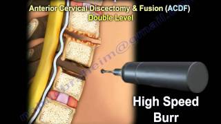 Cervical Spine Decompression And Fusion   Everything You Need To Know  Dr Nabil Ebraheim [upl. by Michigan]