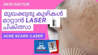 acne scars laser treatment malayalammalayalam acnescars acnetreatment laser [upl. by Jannel911]