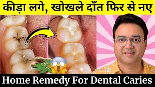 दांत में लगा कीड़ा खोखला दांत फिर से नए जैसा  Remedy For Tooth Cavity  Dental Caries [upl. by Yarled]