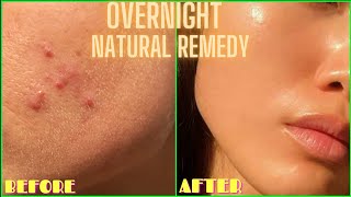 HOW TO GET RID OF ACNE PIMPLES BUMPS ON FACE OVERNIGHT  Simple Home Remedy DIY Lemon Treatment [upl. by Suidualc]