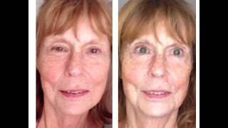 Microcurrent Facelift and the eyes what you can expect after a series of treatments [upl. by Eicul]