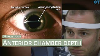 Anterior Chamber Inflammation [upl. by Yditsahc417]