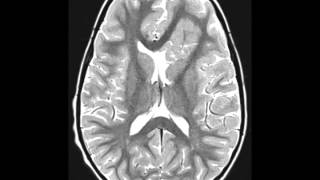 Cortical Dysplasia [upl. by Ecyaj]