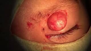 Molluscum Contagiosum Lesions Excision [upl. by Nylzaj]