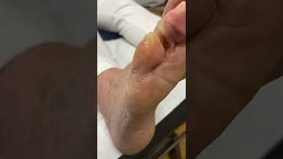 Experience pain relief Watch an Aussie podiatrist remove corns amp calluses [upl. by Celtic]