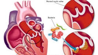 اقوى شرح Endocarditis بالتفصيل 💗🥰💫💯 [upl. by Anirad]