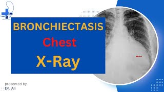 Bronchiectasis X Ray Bronchiectasis Chest X Ray Findings [upl. by Alleber]