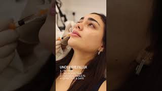 Dark Circles Treatment fillers  فيلر تحت العين [upl. by Beare]