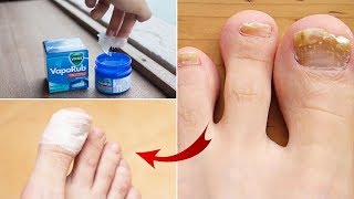 5 Simple And Effective Home Remedies To Treat Toenail Fungus At Home Naturally by Step to Health [upl. by Stokes]