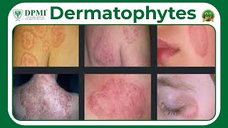 Dermatophyte Infection Types Of Dermatophytes Dermatophyte Symptoms Diagnosis And Treatment [upl. by Vorster]