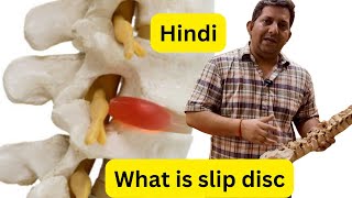 Know everything about Slip Disc amp Treatment In Hindi [upl. by Bej119]