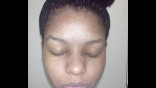 How kojic acid soap changed my face week 4 before and after pictures [upl. by Anitnamaid]