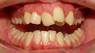 Braces  Before and After Time Lapse [upl. by Odom151]