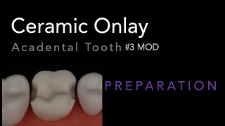 MOD Ceramic Onlay 3 Acadental  Dr Richard Stevenson [upl. by Crisey]