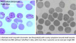 24 Practical Parasitology  Plasmodium Falciparum  Ring Stage [upl. by Kcirad]