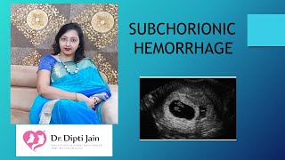 SUBCHORIONIC HAEMORRHAGE Causes amp Treatment [upl. by Ardnuhsed422]