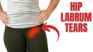 Hip Labral Tear What It Is How to Know If You Have It and What To Do About It [upl. by Bradney23]