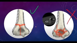 Complex Distal Intercondylar humerus Fractures Part I surgical planning [upl. by Friedrich]