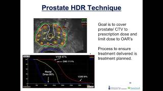 High Dose Rate HDR Prostate Brachytherapy Lecture [upl. by Seen436]