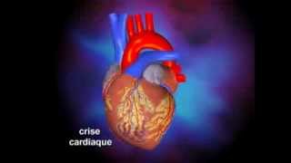 Infarctus du myocarde [upl. by Anagnos]