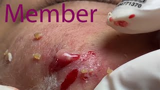 Acne Treatment Huong Da Nang 024  fans membership [upl. by Malilliw]