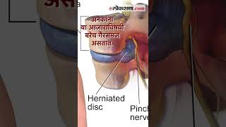 ‘डिस्क’चं आरोग्य कसं बिघडतं जाणून घ्या तज्ज्ञांकडून  Slipped Disc  Health [upl. by Rehpitsirhc219]