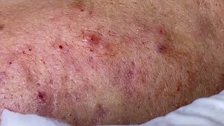 Big Cystic Acne Blackheads Extraction Blackheads amp Milia Whiteheads Removal Pimple Popping [upl. by Annawahs]