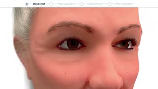 Patientfilm om ögonlocksplastik  förhandsvisning Eyelid surgery  preview [upl. by Earazed]