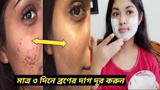 ৩ দিনে ব্রণের দাগ দূর করার উপায়। Remove acne  pimple dark spots Broner dag dur korar upayFACEPACK [upl. by Drahser]