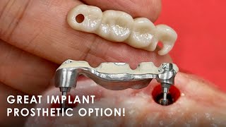 A Great Implant Prosthetic Option [upl. by Vilberg]